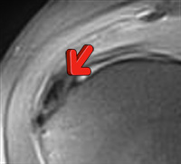 Kernspintomographie Detailbild mit Kalkherd in einer Sehne der Schulter