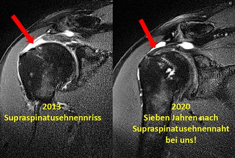 Naht Supraspinatussehne nach sieben Jahren