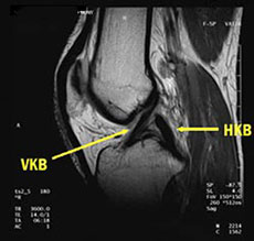 knee mri